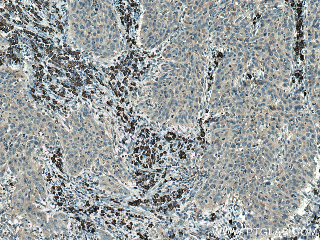 Immunohistochemistry (IHC) staining of human cervical cancer tissue using ATG7 Polyclonal antibody (28413-1-AP)