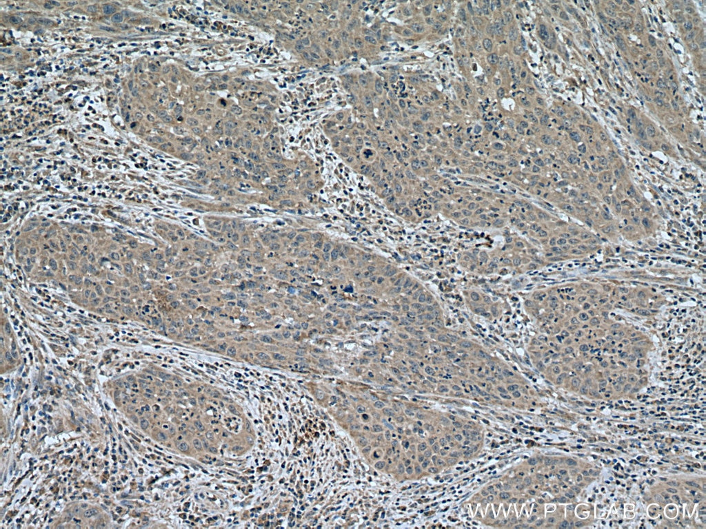 Immunohistochemistry (IHC) staining of human cervical cancer tissue using ATG7 Monoclonal antibody (67341-1-Ig)