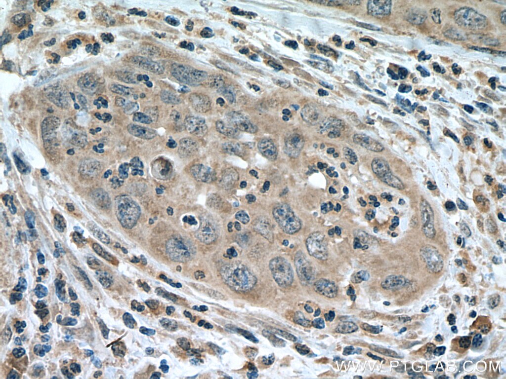 IHC staining of human cervical cancer using 67341-1-Ig