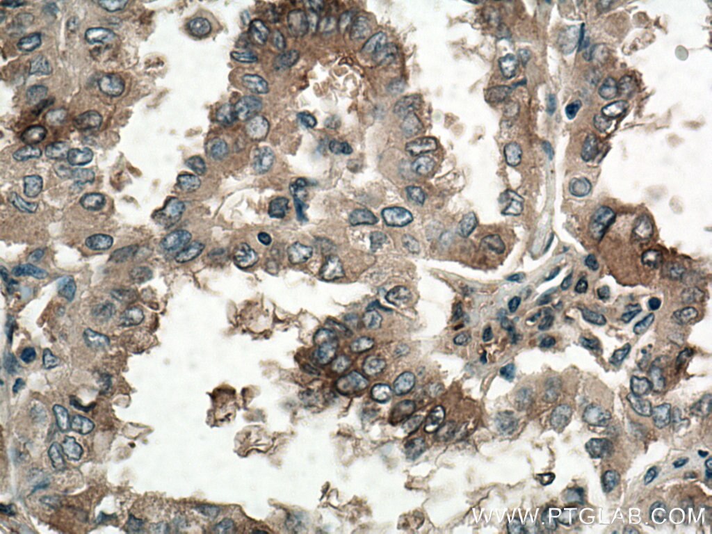 Immunohistochemistry (IHC) staining of human thyroid cancer tissue using ATG9A Monoclonal antibody (67096-1-Ig)