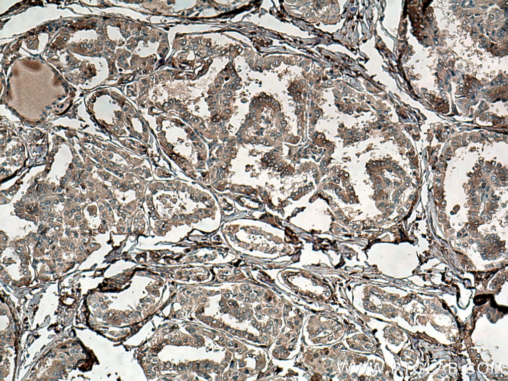 Immunohistochemistry (IHC) staining of human thyroid cancer tissue using ATG9A Monoclonal antibody (67096-1-Ig)