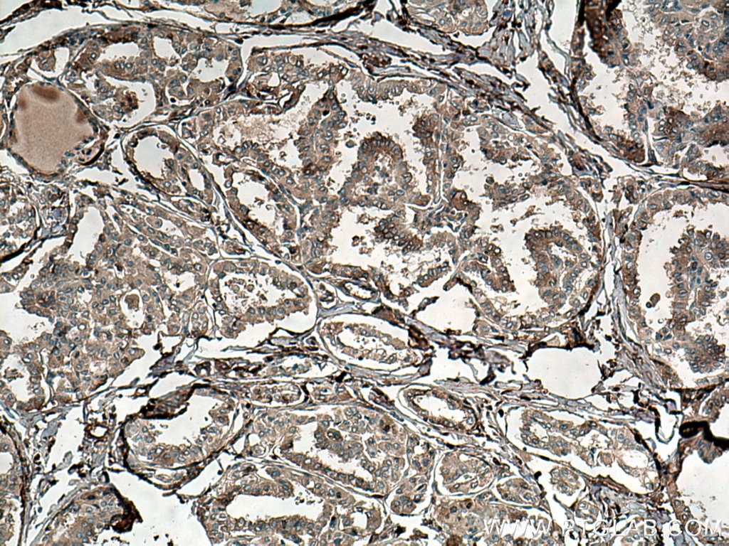 IHC staining of human thyroid cancer using 67096-1-Ig