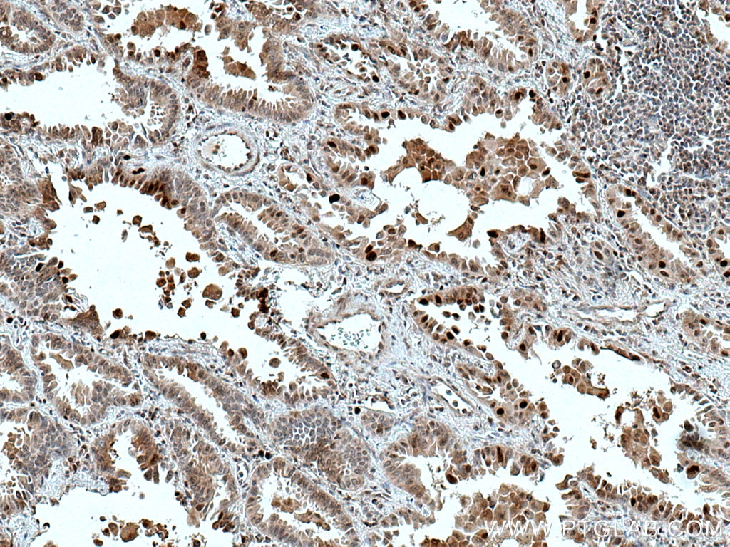 Immunohistochemistry (IHC) staining of human lung cancer tissue using ATM Polyclonal antibody (27156-1-AP)