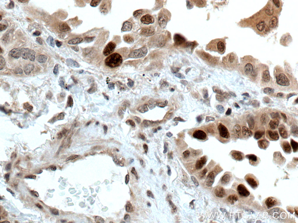 Immunohistochemistry (IHC) staining of human lung cancer tissue using ATM Polyclonal antibody (27156-1-AP)