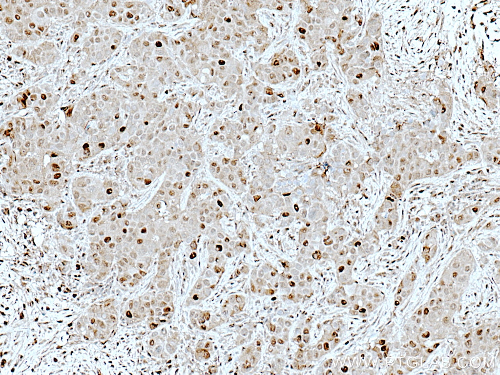IHC staining of human breast cancer using 27156-1-AP
