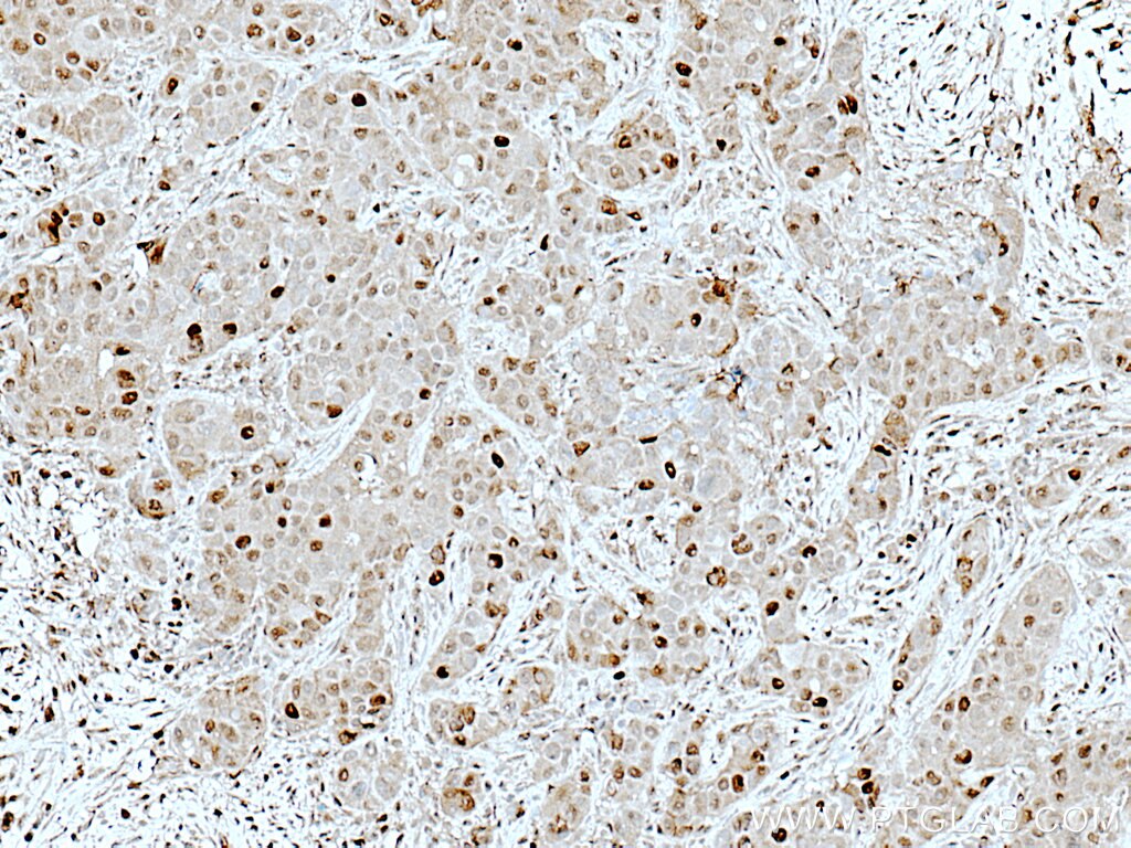 Immunohistochemistry (IHC) staining of human breast cancer tissue using ATM Polyclonal antibody (27156-1-AP)