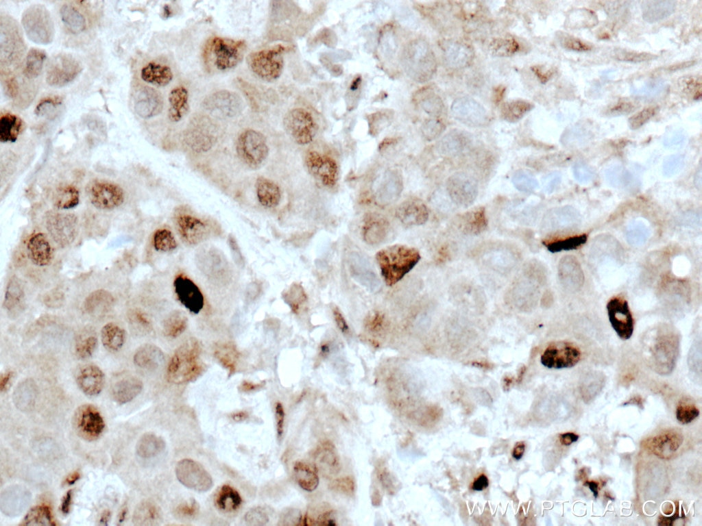 Immunohistochemistry (IHC) staining of human breast cancer tissue using ATM Polyclonal antibody (27156-1-AP)