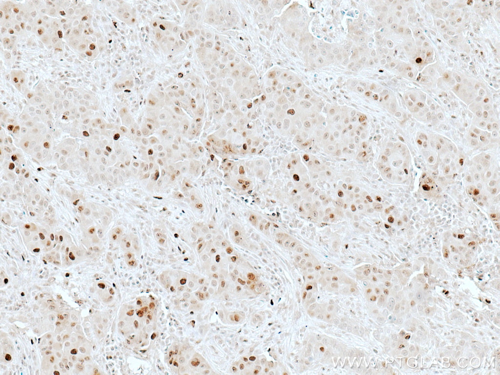 Immunohistochemistry (IHC) staining of human breast cancer tissue using ATM Polyclonal antibody (27156-1-AP)