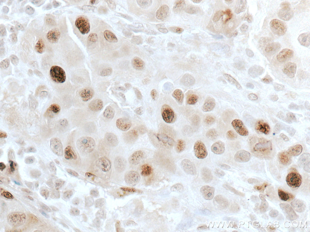 Immunohistochemistry (IHC) staining of human breast cancer tissue using ATM Polyclonal antibody (27156-1-AP)