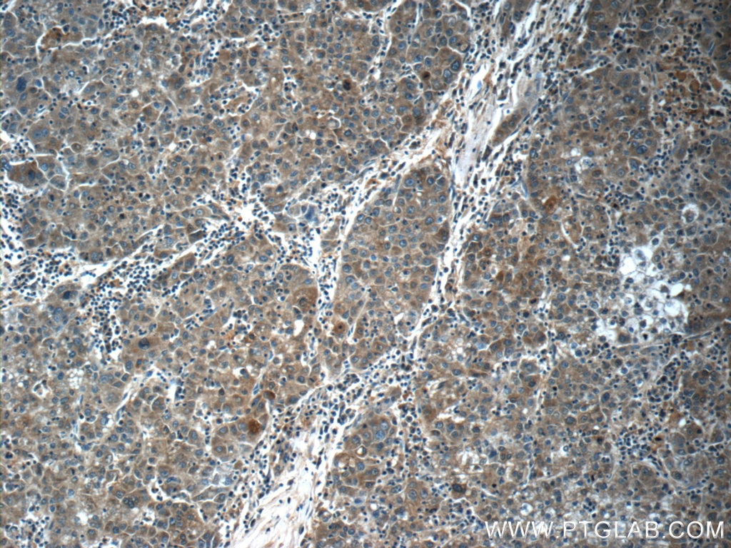 Immunohistochemistry (IHC) staining of human liver cancer tissue using ATOX1 Polyclonal antibody (22641-1-AP)