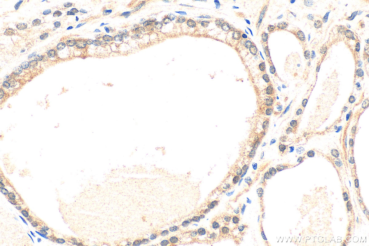 Immunohistochemical analysis of paraffin-embedded human prostate hyperplasia tissue slide using 22641-1-AP (ATOX1 antibody) at dilution of 1:200 (under 40x lens). Heat mediated antigen retrieval with Tris-EDTA buffer (pH 9.0). Immunohistochemistry (IHC) staining of human prostate hyperplasia tissue using ATOX1 Polyclonal antibody (22641-1-AP)