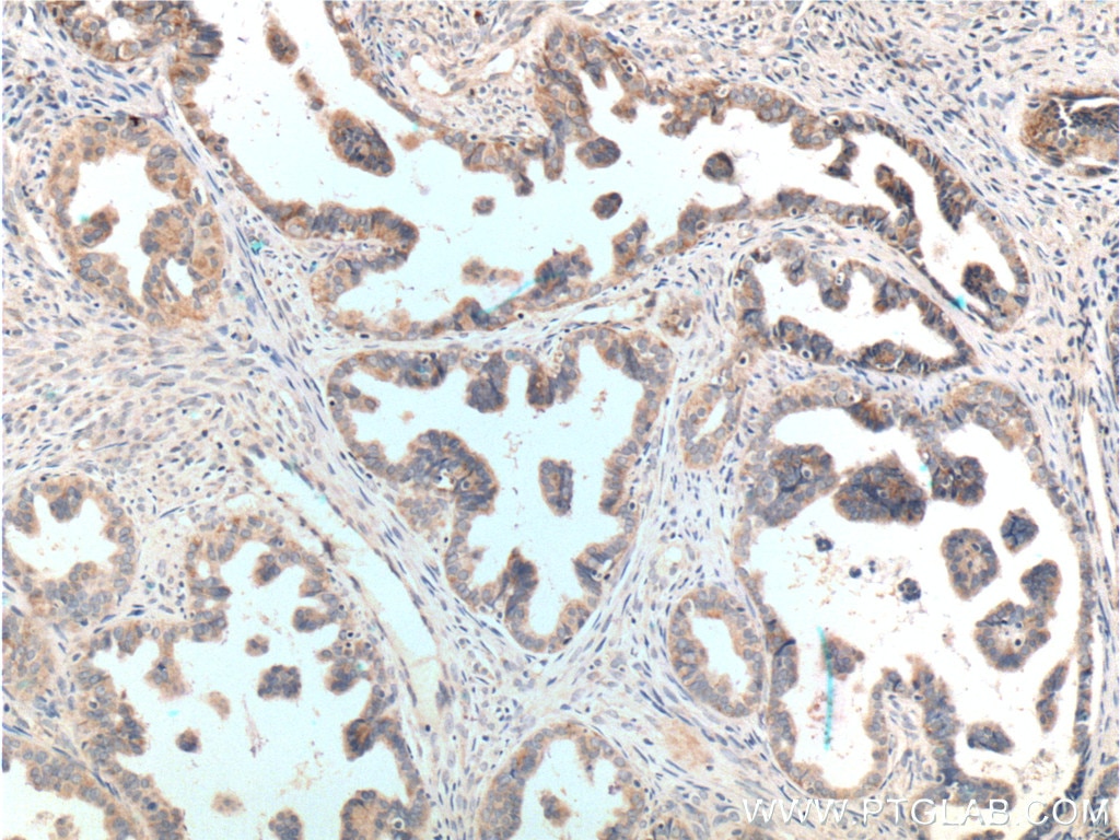 Immunohistochemistry (IHC) staining of human ovary tumor tissue using ATP11B Polyclonal antibody (13672-1-AP)