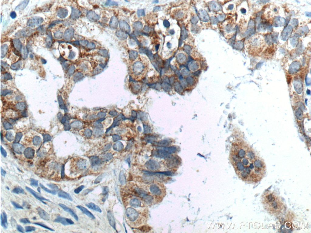 Immunohistochemistry (IHC) staining of human ovary tumor tissue using ATP11B Polyclonal antibody (13672-1-AP)