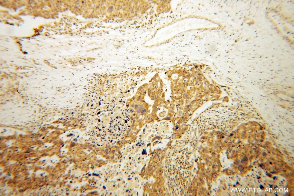 Immunohistochemistry (IHC) staining of human ovary tumor tissue using ATP11B Polyclonal antibody (13672-1-AP)