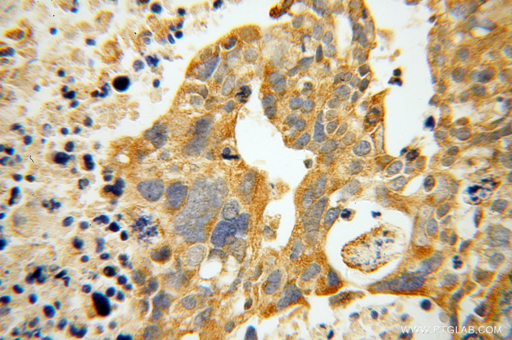 Immunohistochemistry (IHC) staining of human ovary tumor tissue using ATP11B Polyclonal antibody (13672-1-AP)