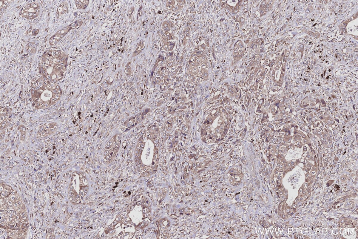 IHC staining of human pancreas cancer using 16244-1-AP Immunohistochemistry (IHC) staining of human pancreas cancer tissue using ATP13A1 Polyclonal antibody (16244-1-AP)