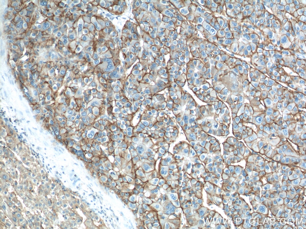 Immunohistochemistry (IHC) staining of human liver cancer tissue using ATP1A1 Polyclonal antibody (14418-1-AP)