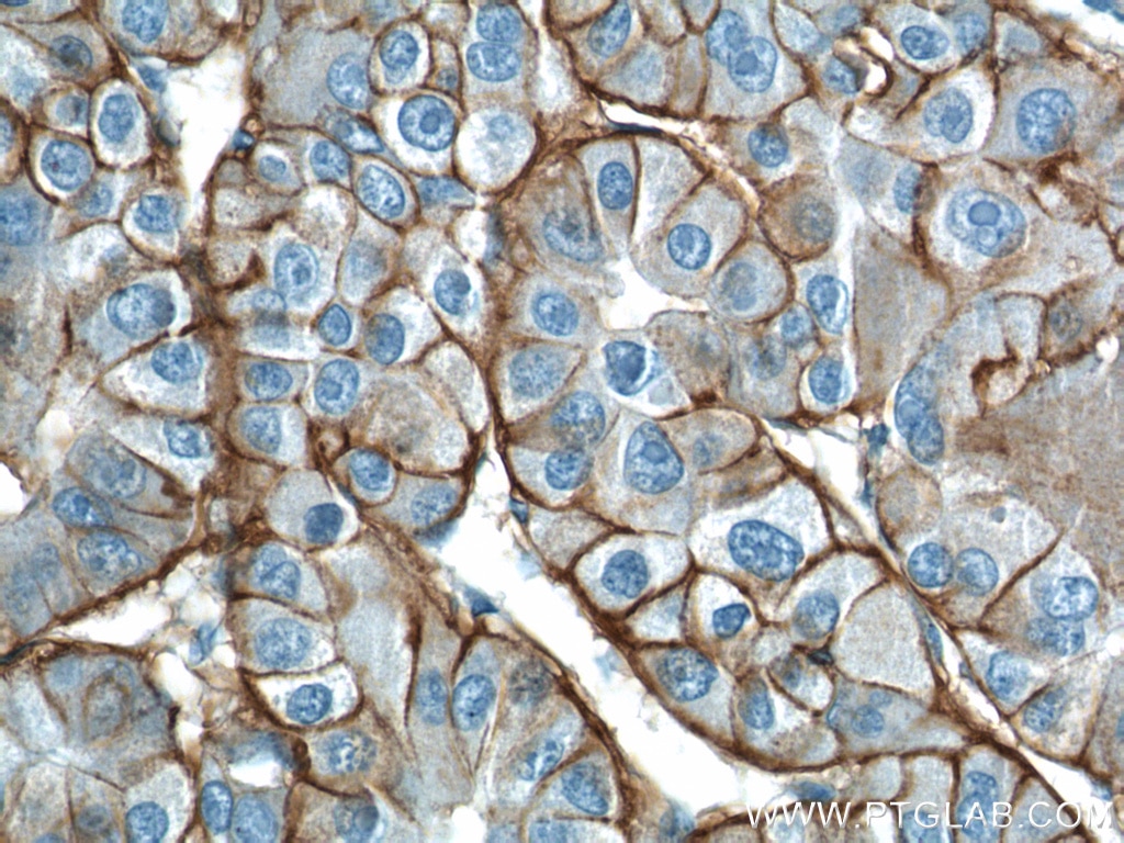 Immunohistochemistry (IHC) staining of human liver cancer tissue using ATP1A1 Polyclonal antibody (14418-1-AP)