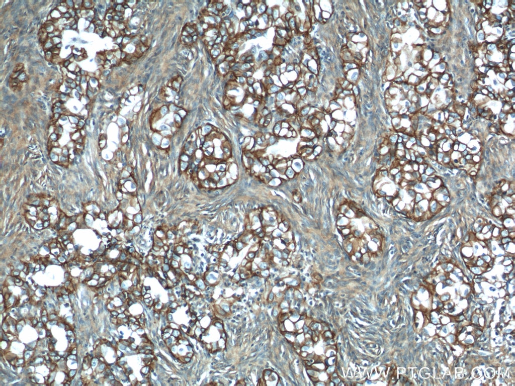 Immunohistochemistry (IHC) staining of human ovary tumor tissue using ATP1A1 Polyclonal antibody (14418-1-AP)