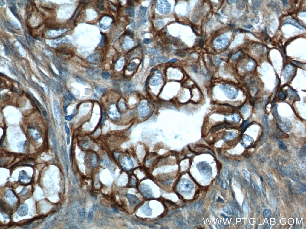 IHC staining of human ovary tumor using 14418-1-AP