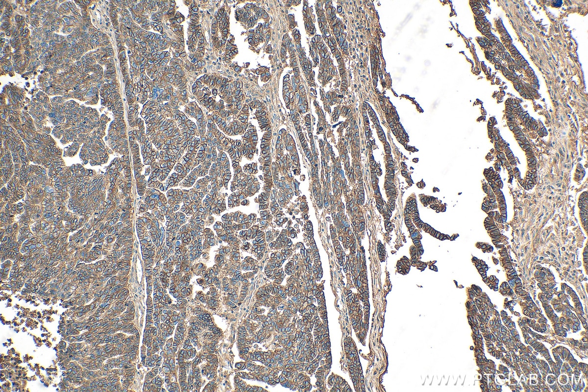 Immunohistochemistry (IHC) staining of human ovary tumor tissue using ATP1A1 Polyclonal antibody (14418-1-AP)