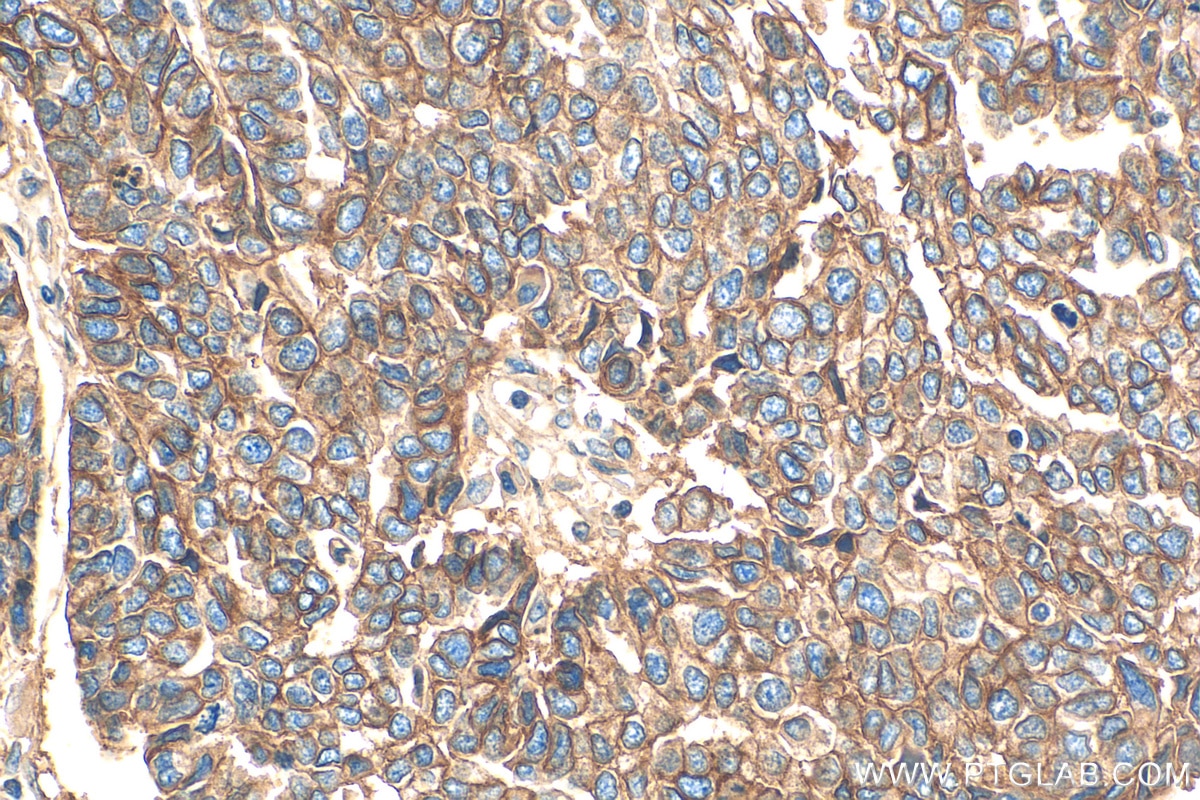 Immunohistochemistry (IHC) staining of human ovary tumor tissue using ATP1A1 Polyclonal antibody (14418-1-AP)