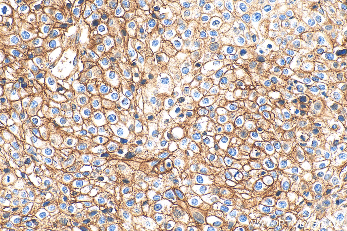 Immunohistochemistry (IHC) staining of human cervical cancer tissue using ATP1A1 Polyclonal antibody (14418-1-AP)