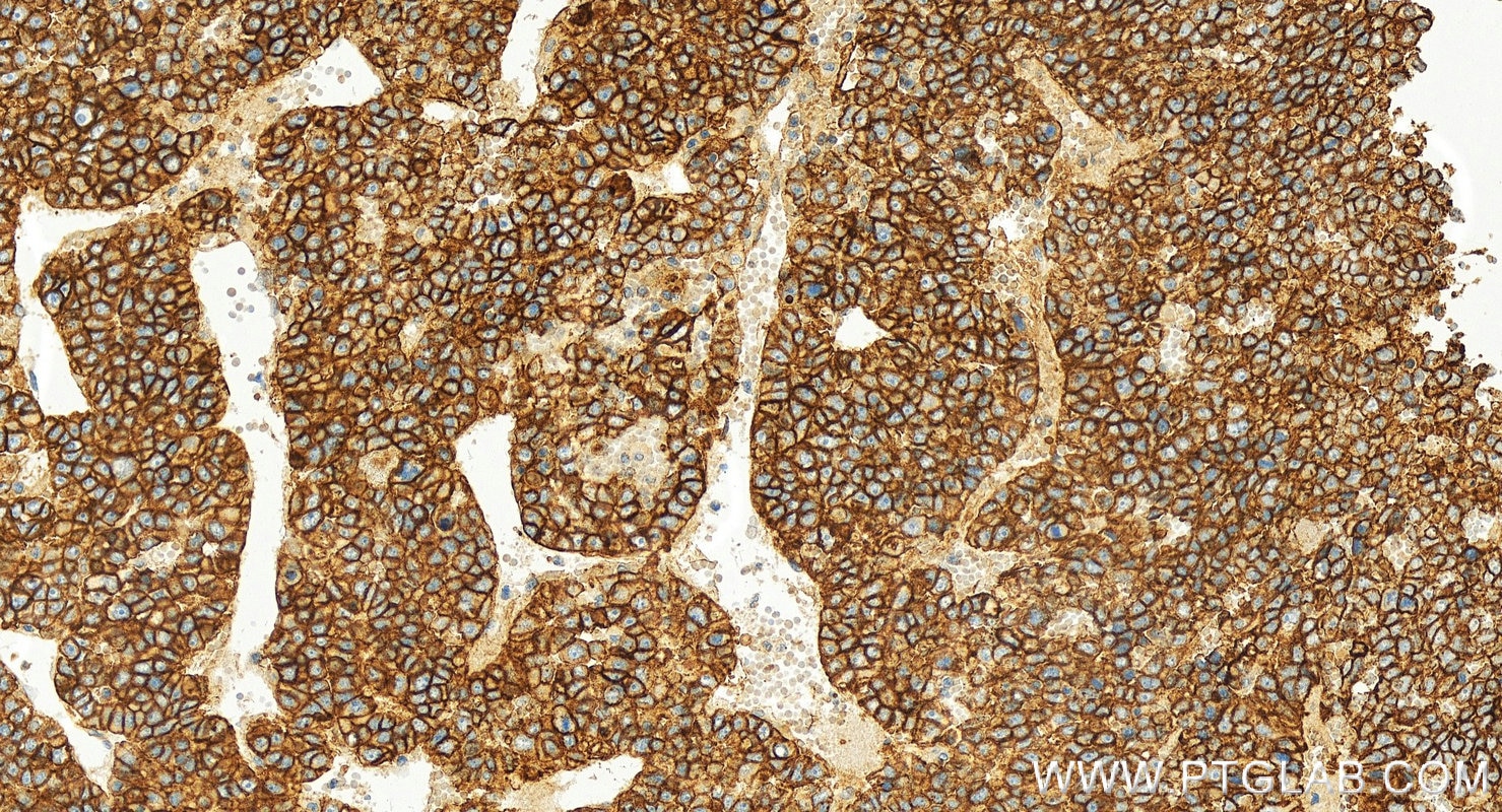 Immunohistochemical analysis of paraffin-embedded human hepatocellular ca slide using 55187-1-AP (ATP1A1-Specific antibody) at dilution of 1:1000 (under 20x lens). Heat mediated antigen retrieval with Tris-EDTA buffer (pH 9.0). Immunohistochemistry (IHC) staining of human hepatocellular ca using ATP1A1-Specific Polyclonal antibody (55187-1-AP)