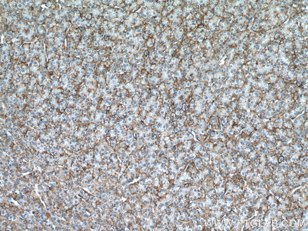 Immunohistochemistry (IHC) staining of human liver cancer tissue using ATP1A1-Specific Polyclonal antibody (55187-1-AP)
