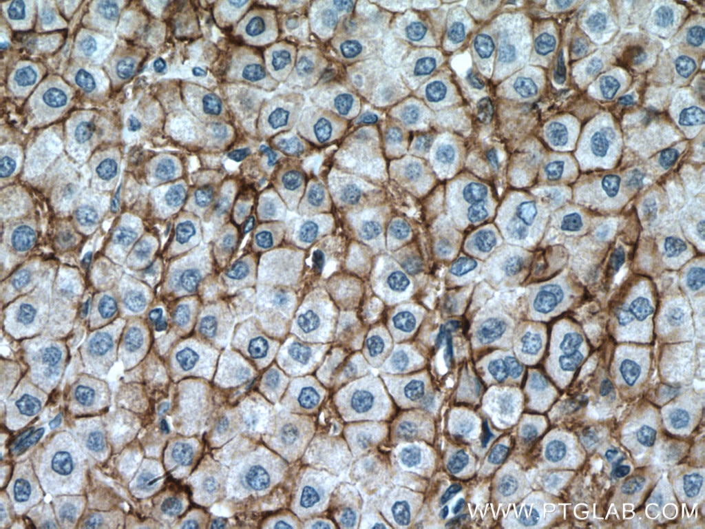 Immunohistochemistry (IHC) staining of human liver cancer tissue using ATP1A1-Specific Polyclonal antibody (55187-1-AP)