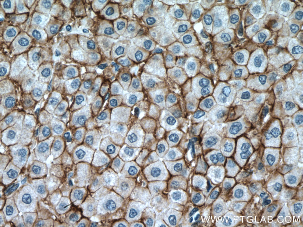 IHC staining of human liver cancer using 55187-1-AP