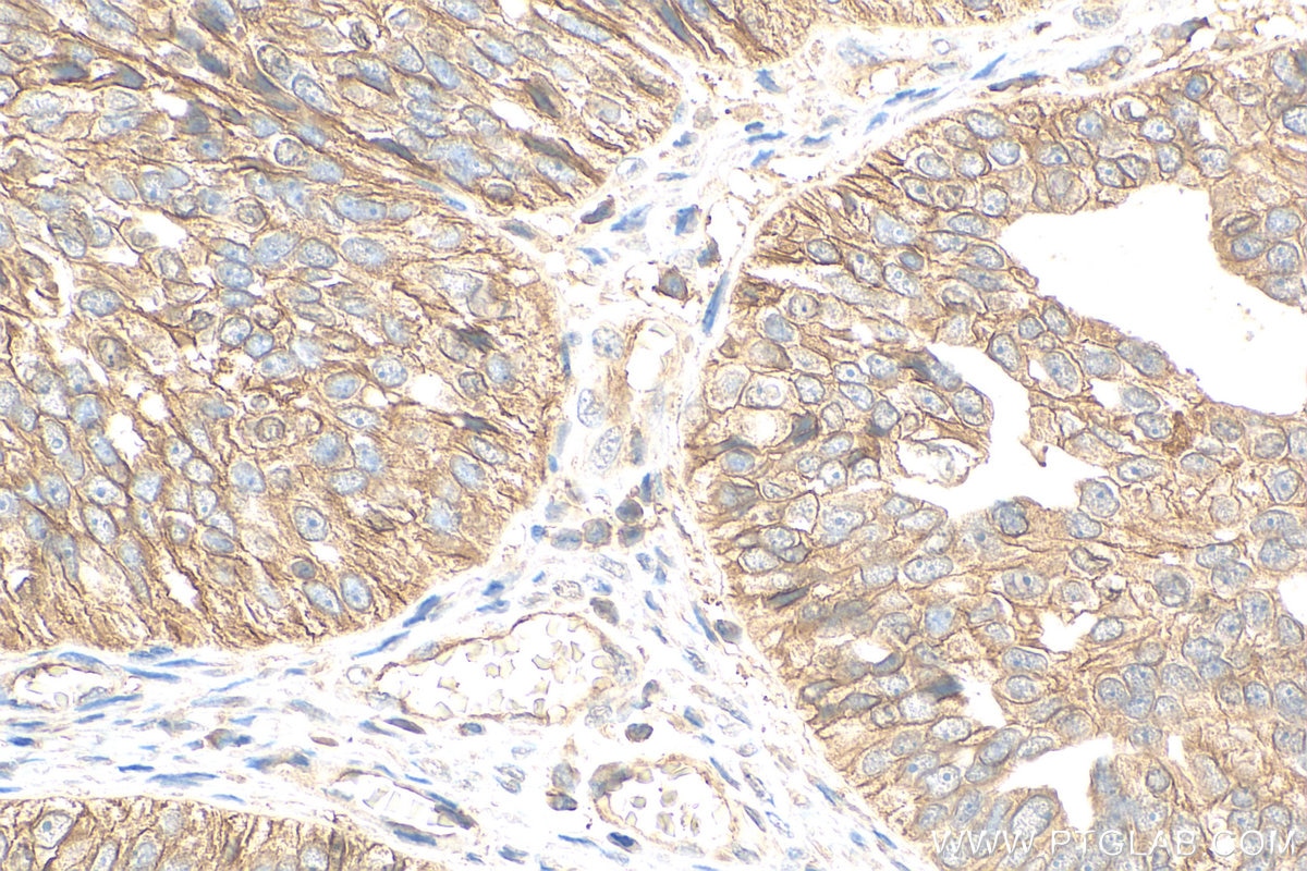 Immunohistochemistry (IHC) staining of human ovary cancer tissue using ATP1A1-Specific Polyclonal antibody (55187-1-AP)