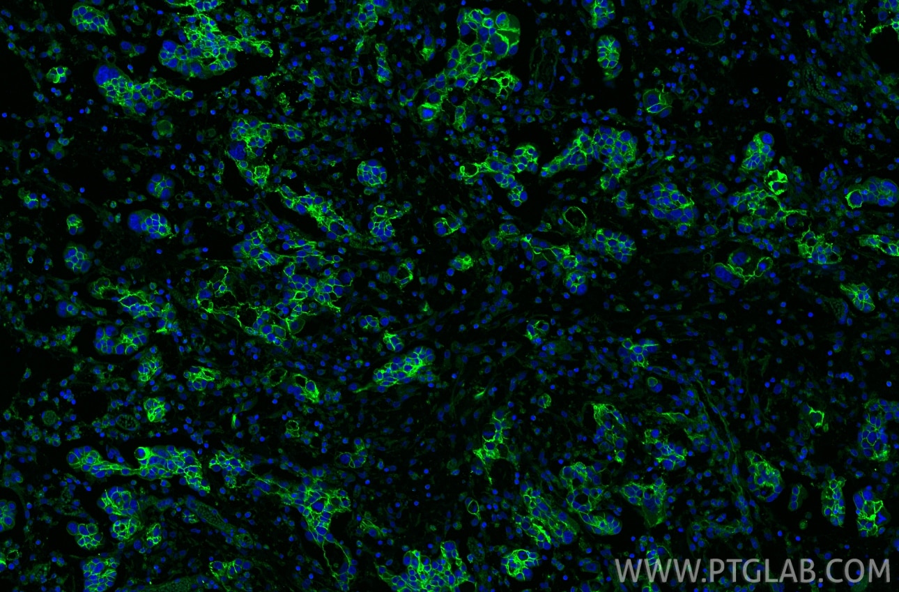 Immunofluorescence (IF) / fluorescent staining of human ovary cancer tissue using ATP1A1 Monoclonal antibody (68735-2-Ig)