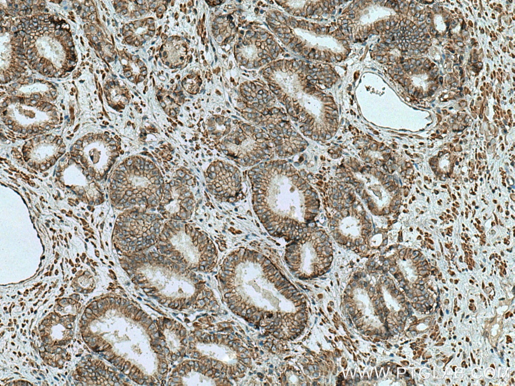 IHC staining of human prostate cancer using 10868-1-AP