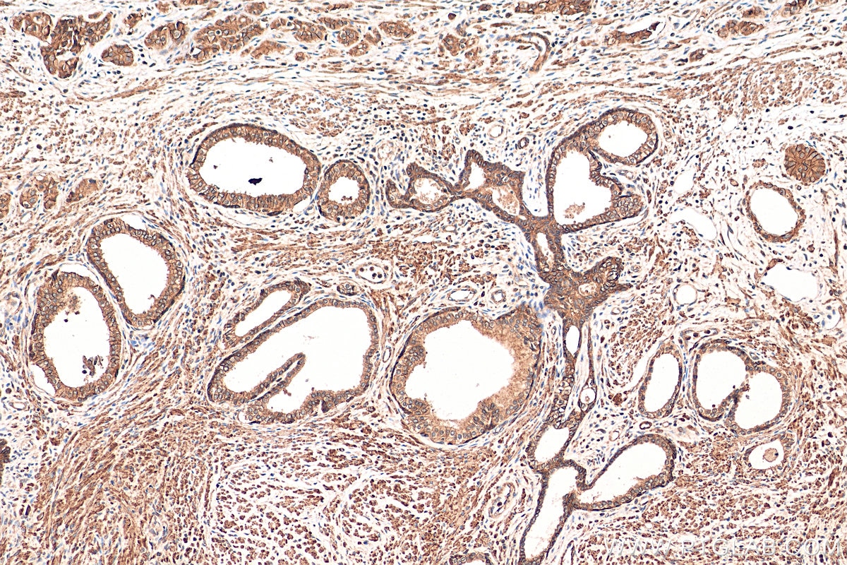 Immunohistochemistry (IHC) staining of human prostate cancer tissue using ATP1A3 (C-terminal) Polyclonal antibody (10868-1-AP)