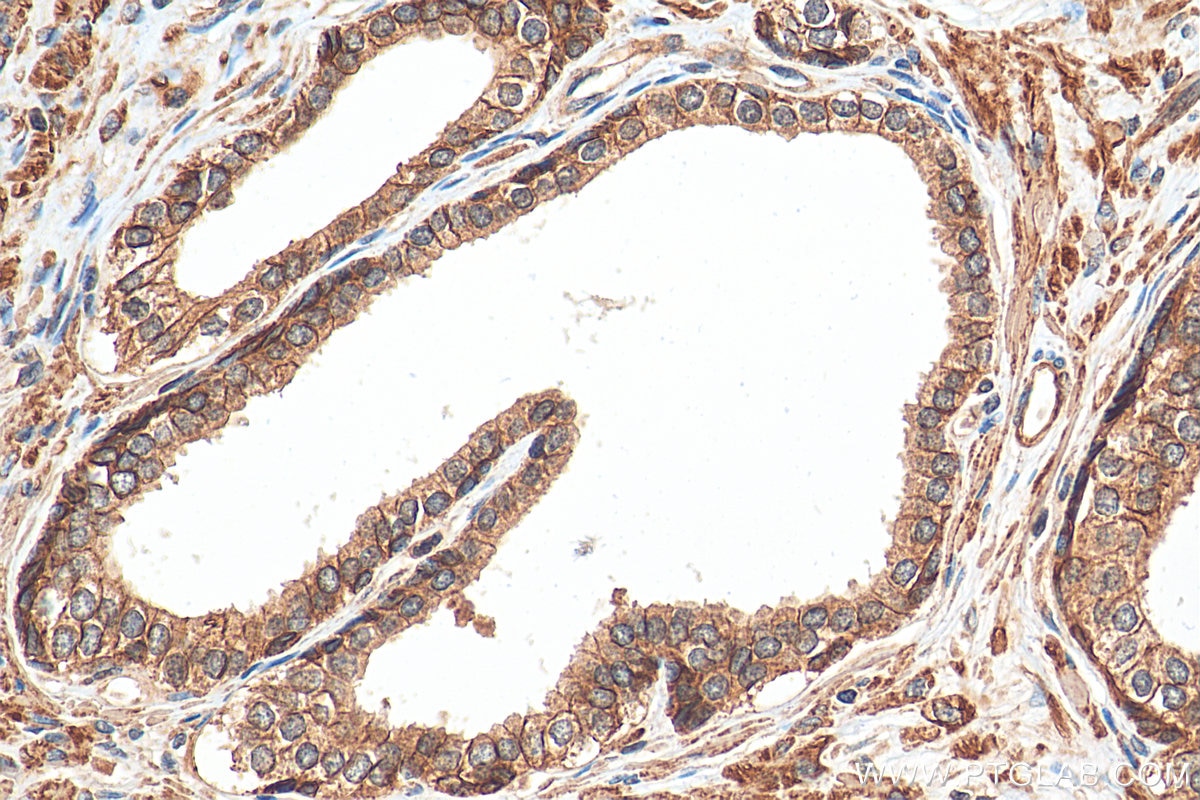 Immunohistochemistry (IHC) staining of human prostate cancer tissue using ATP1A3 (C-terminal) Polyclonal antibody (10868-1-AP)