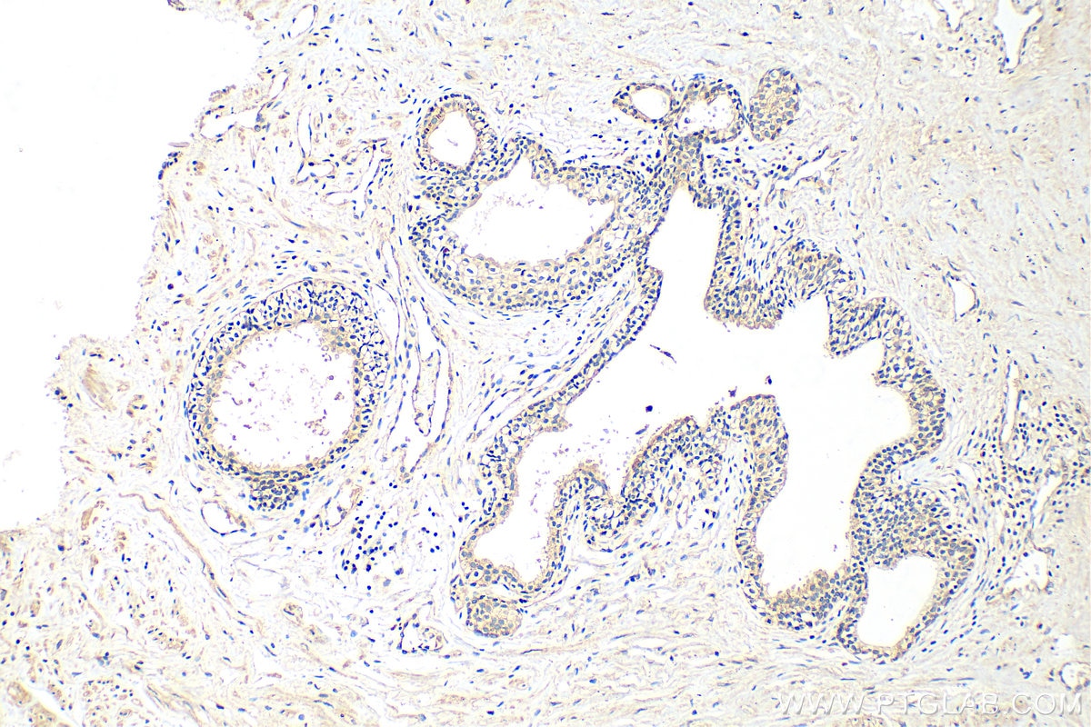 Immunohistochemistry (IHC) staining of human prostate cancer tissue using ATP1A3 Polyclonal antibody (25727-1-AP)