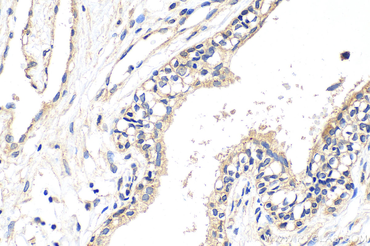 Immunohistochemistry (IHC) staining of human prostate cancer tissue using ATP1A3 Polyclonal antibody (25727-1-AP)