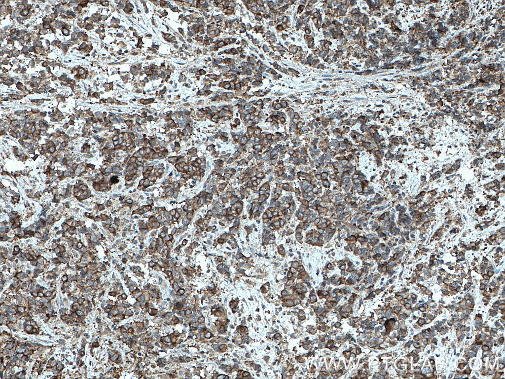 Immunohistochemistry (IHC) staining of human prostate cancer tissue using ATP1A3 (middle) Polyclonal antibody (28030-1-AP)