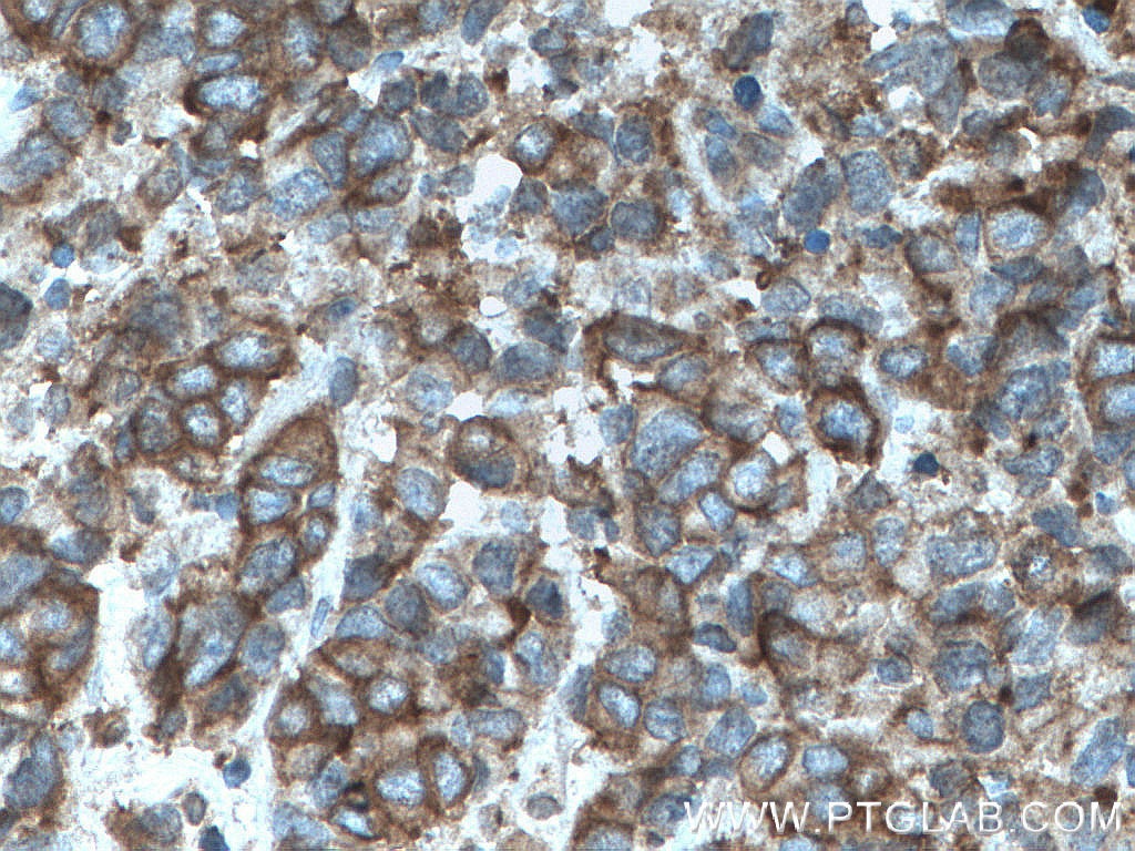 Immunohistochemistry (IHC) staining of human prostate cancer tissue using ATP1A3 (middle) Polyclonal antibody (28030-1-AP)