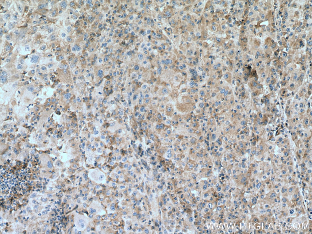 Immunohistochemistry (IHC) staining of human liver cancer tissue using ATP1B3 Polyclonal antibody (11142-1-AP)