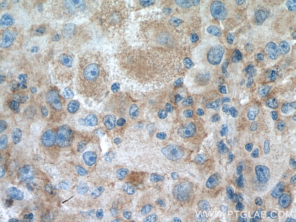 Immunohistochemistry (IHC) staining of human liver cancer tissue using ATP1B3 Polyclonal antibody (11142-1-AP)