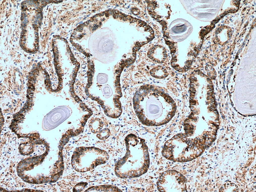 Immunohistochemistry (IHC) staining of human prostate cancer tissue using ATP1B3 Polyclonal antibody (11142-1-AP)