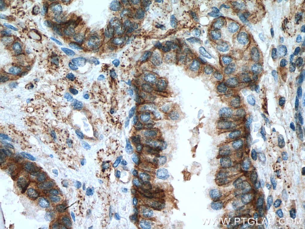 Immunohistochemistry (IHC) staining of human prostate cancer tissue using ATP1B3 Polyclonal antibody (11142-1-AP)