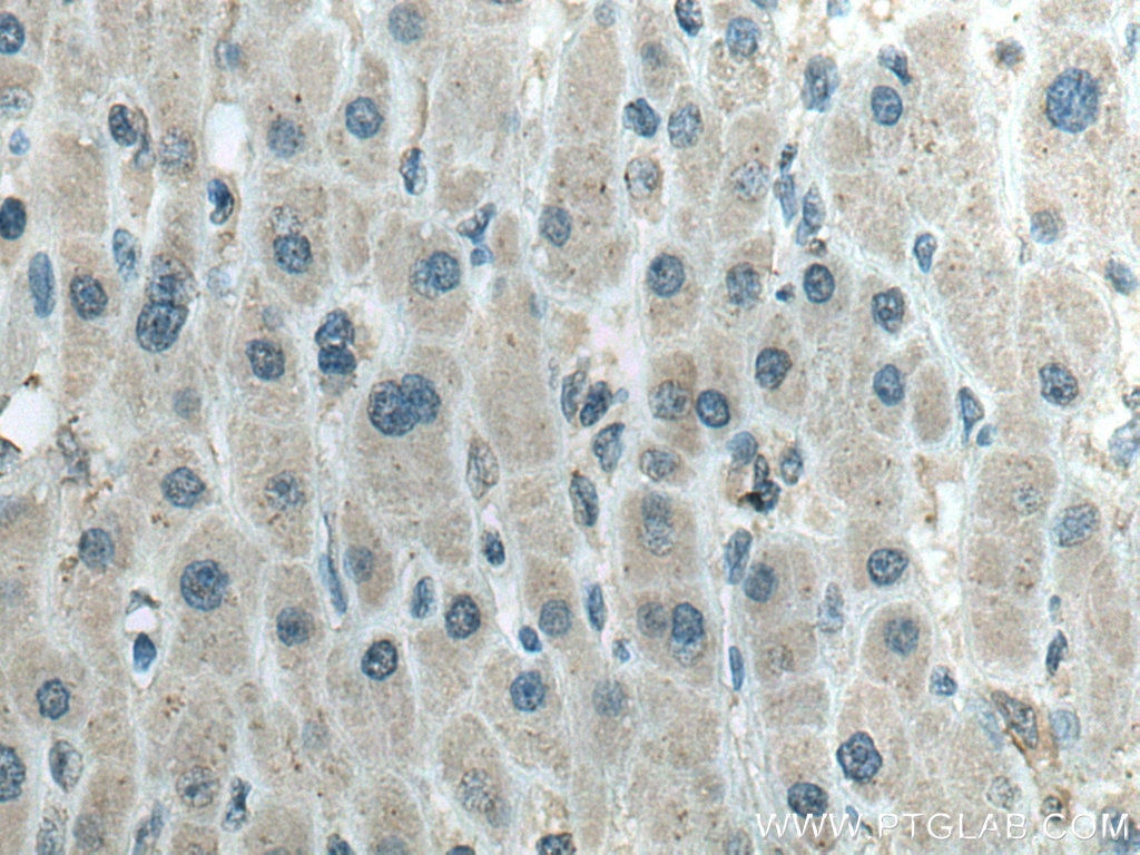 Immunohistochemistry (IHC) staining of human liver cancer tissue using ATP1B3 Monoclonal antibody (67554-1-Ig)