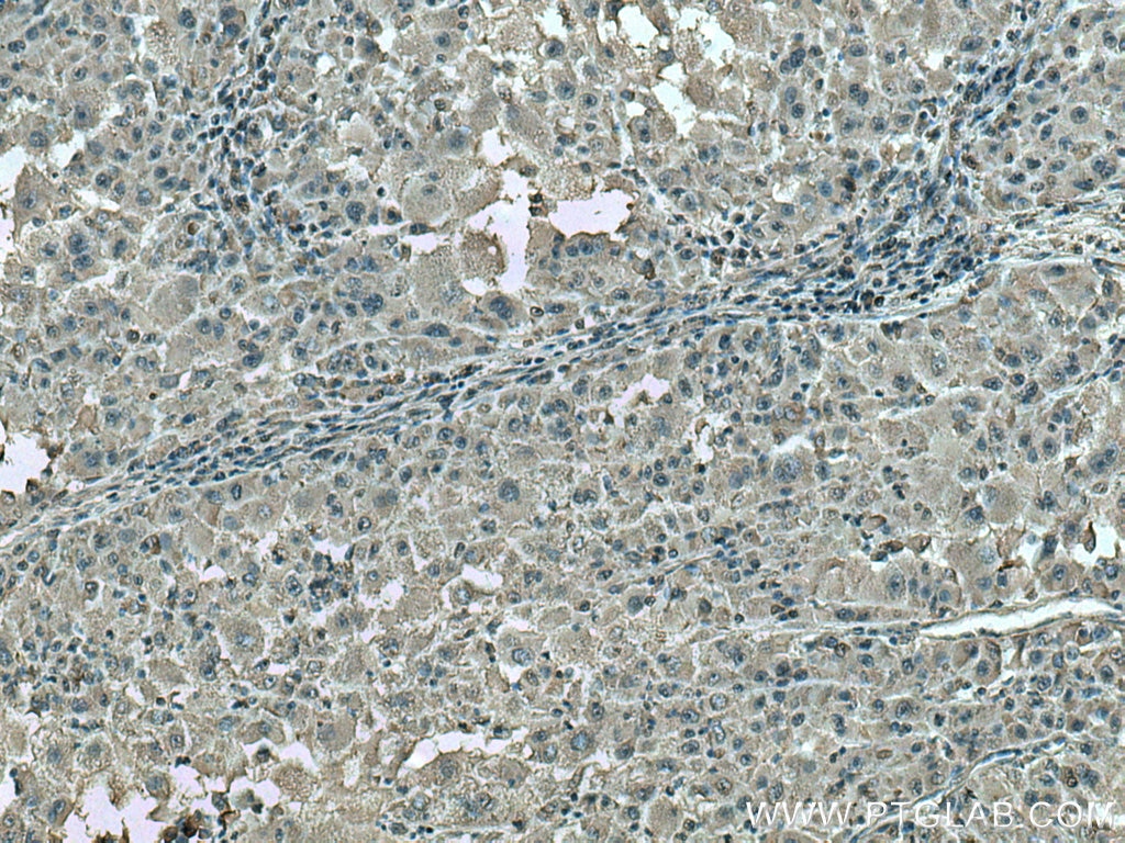 Immunohistochemistry (IHC) staining of human liver cancer tissue using ATP1B3 Monoclonal antibody (67554-1-Ig)