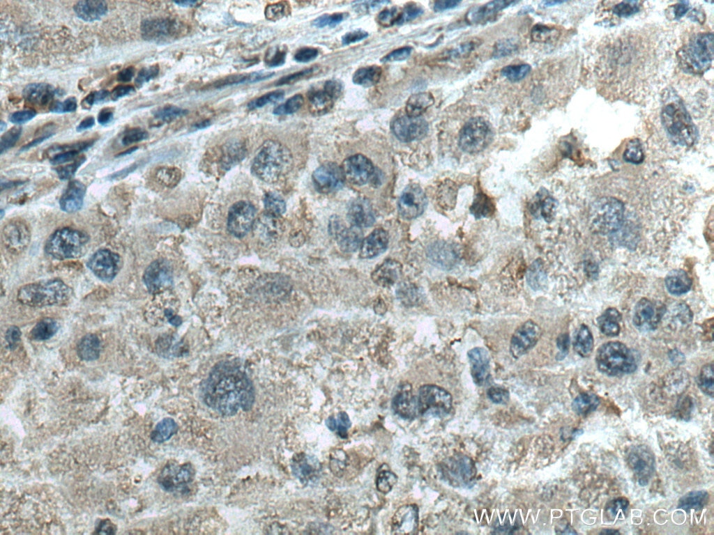 Immunohistochemistry (IHC) staining of human liver cancer tissue using ATP1B3 Monoclonal antibody (67554-1-Ig)