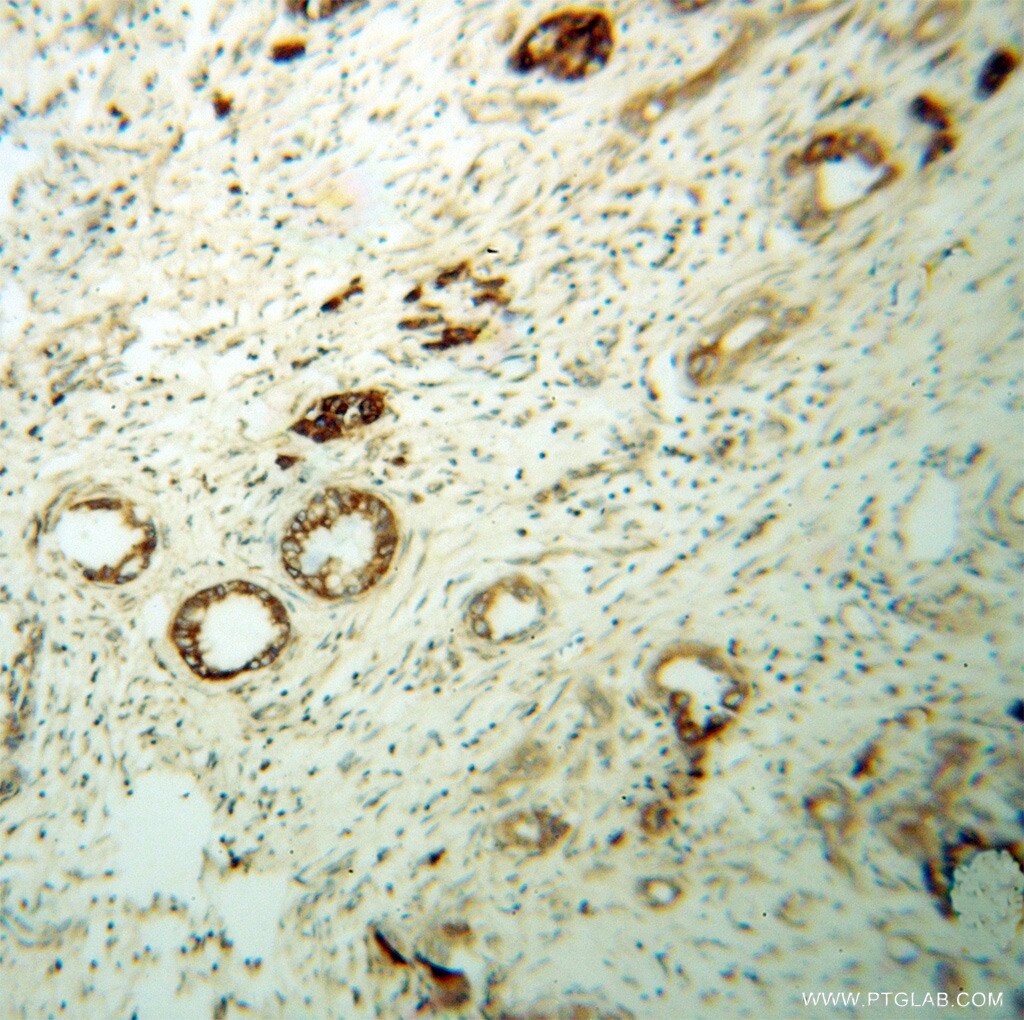 Immunohistochemistry (IHC) staining of human pancreas cancer tissue using SERCA3 Polyclonal antibody (13619-1-AP)