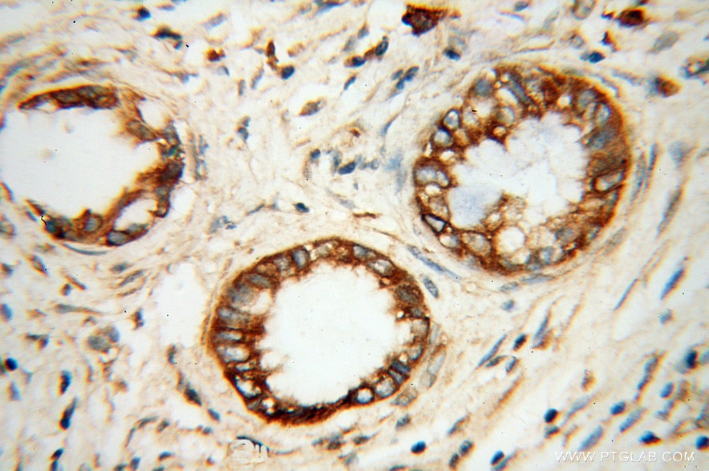 Immunohistochemistry (IHC) staining of human pancreas cancer tissue using SERCA3 Polyclonal antibody (13619-1-AP)