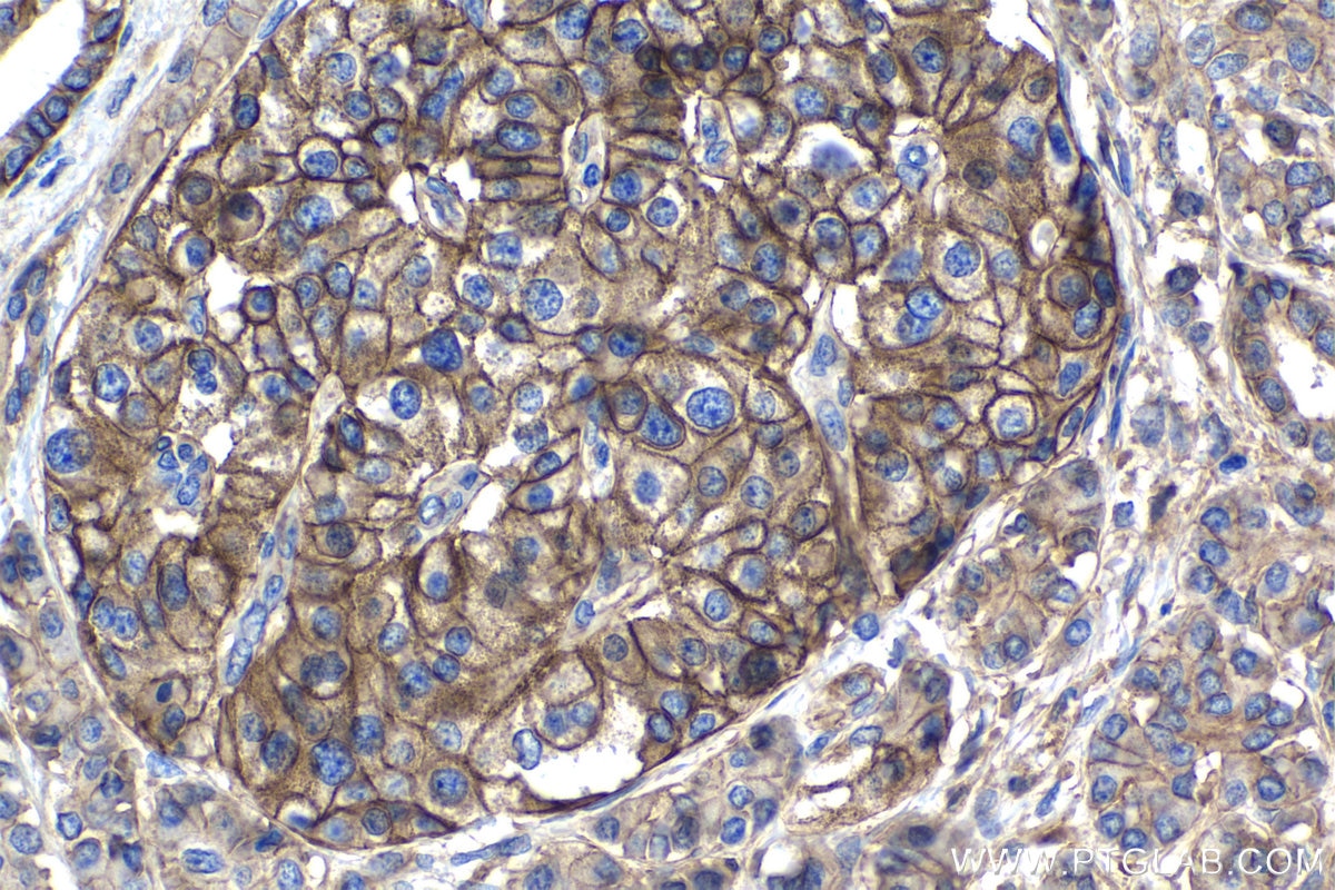 Immunohistochemistry (IHC) staining of human pancreas cancer tissue using ATP2B1 Polyclonal antibody (30035-1-AP)